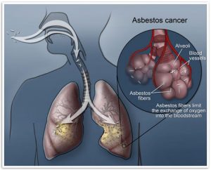 Asbestos cancer